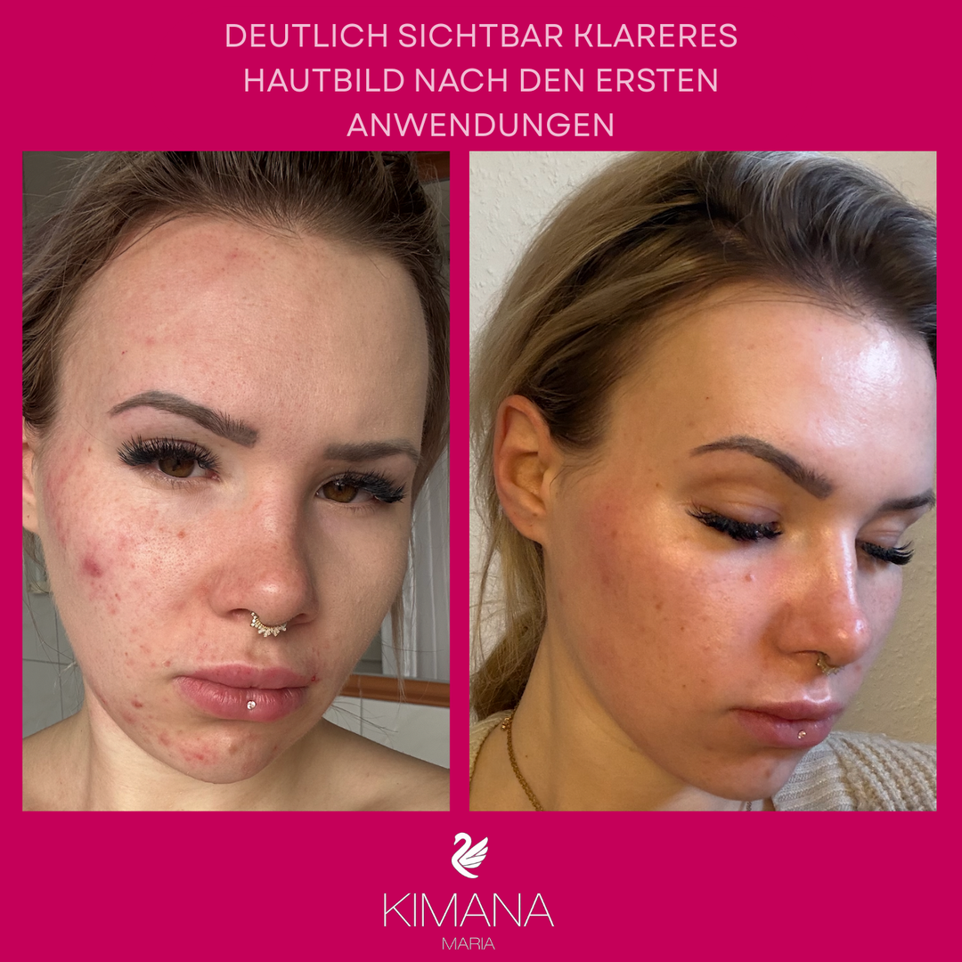 Hormon Starter Set - Unreine Haut